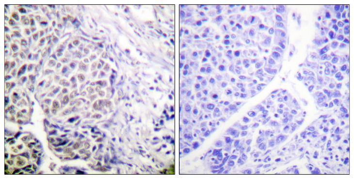 AURKB / Aurora-B Antibody - Immunohistochemistry analysis of paraffin-embedded human liver carcinoma, using AurB (Phospho-Tyr12) Antibody. The picture on the right is blocked with the phospho peptide.