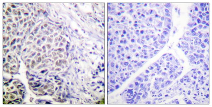 AURKB / Aurora-B Antibody - P-peptide - + Immunohistochemistry analysis of paraffin-embedded human liver carcinoma tissue using AurB (Phospho-Tyr12) antibody.
