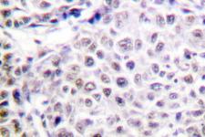 AURKB / Aurora-B Antibody - IHC of AurB (Y8) pAb in paraffin-embedded human liver carcinoma tissue.