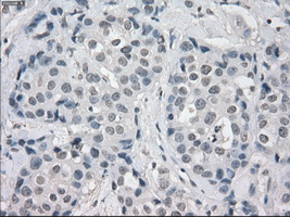 AURKC / Aurora C Antibody - Immunohistochemical staining of paraffin-embedded Adenocarcinoma of breast tissue using anti-AURKC mouse monoclonal antibody. (Dilution 1:50).