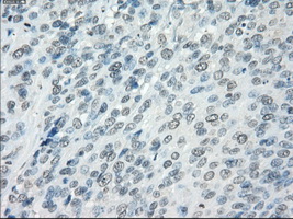AURKC / Aurora C Antibody - Immunohistochemical staining of paraffin-embedded Carcinoma of bladder tissue using anti-AURKC mouse monoclonal antibody. (Dilution 1:50).
