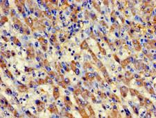 AURKC / Aurora C Antibody - Immunohistochemistry image of paraffin-embedded human liver cancer at a dilution of 1:100