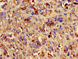 AURKC / Aurora C Antibody - Immunohistochemistry image of paraffin-embedded human melanoma cancer at a dilution of 1:100