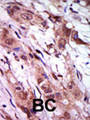 AURKC / Aurora C Antibody - Formalin-fixed and paraffin-embedded human cancer tissue reacted with the primary antibody, which was peroxidase-conjugated to the secondary antibody, followed by AEC staining. This data demonstrates the use of this antibody for immunohistochemistry; clinical relevance has not been evaluated. BC = breast carcinoma; HC = hepatocarcinoma.
