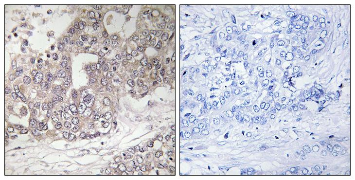 AUTL1 / ATG4C Antibody - Immunohistochemistry analysis of paraffin-embedded human liver carcinoma tissue, using ATG4C Antibody. The picture on the right is blocked with the synthesized peptide.