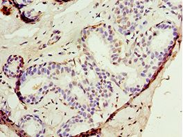 AUTL1 / ATG4C Antibody - Immunohistochemistry of paraffin-embedded human breast cancer using antibody at 1:100 dilution.