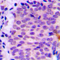 AUTL1 / ATG4C Antibody - Immunohistochemical analysis of ATG4C staining in human prostate cancer formalin fixed paraffin embedded tissue section. The section was pre-treated using heat mediated antigen retrieval with sodium citrate buffer (pH 6.0). The section was then incubated with the antibody at room temperature and detected using an HRP conjugated compact polymer system. DAB was used as the chromogen. The section was then counterstained with hematoxylin and mounted with DPX. w