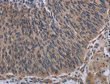 AVEN / PDCD12 Antibody - Immunohistochemistry of paraffin-embedded Human lung cancer using AVEN Polyclonal Antibody at dilution of 1:30.