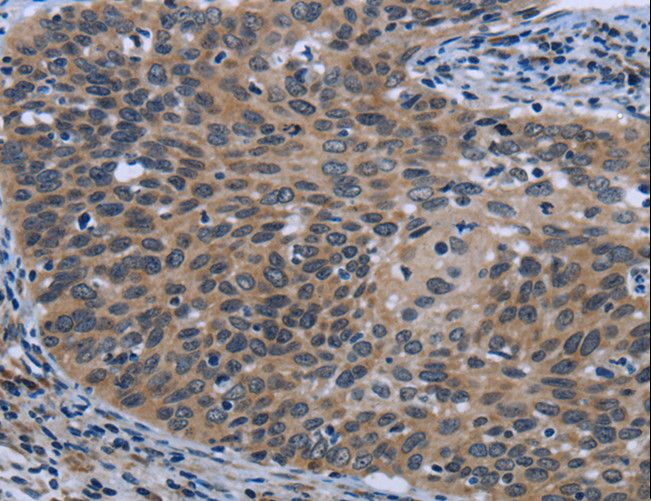 AVEN / PDCD12 Antibody - Immunohistochemistry of paraffin-embedded Human cervical cancer using AVEN Polyclonal Antibody at dilution of 1:30.