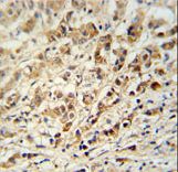 AVL9 Antibody - AVL9 Antibody immunohistochemistry of formalin-fixed and paraffin-embedded human breast carcinoma followed by peroxidase-conjugated secondary antibody and DAB staining.