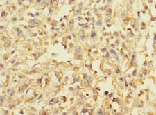 AVPI1 Antibody - Immunohistochemistry of paraffin-embedded human melanoma using AVPI1 Antibody at dilution of 1:100