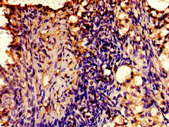 AVPR2 / V2R Antibody - Immunohistochemistry image of paraffin-embedded human ovarian cancer at a dilution of 1:100