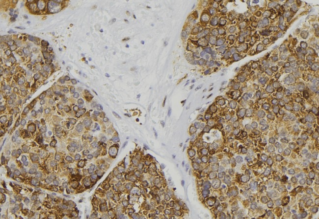 AWAT2 / DGAT2L4 Antibody - 1:100 staining human pancreas tissue by IHC-P. The sample was formaldehyde fixed and a heat mediated antigen retrieval step in citrate buffer was performed. The sample was then blocked and incubated with the antibody for 1.5 hours at 22°C. An HRP conjugated goat anti-rabbit antibody was used as the secondary.