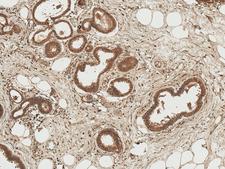 AXIN1 / Axin-1 Antibody - Immunohistochemistry analysis using Rabbit Anti-Axin 1 Polyclonal Antibody. Tissue: Breast. Species: Human. Fixation: Formalin Fixed Paraffin-Embedded. Primary Antibody: Rabbit Anti-Axin 1 Polyclonal Antibody  at 1:50 for 30 min at RT. Counterstain: Hematoxylin. Magnification: 10X. HRP-DAB Detection.