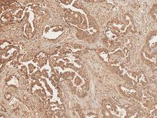 AXIN2 / Axin 2 Antibody - Immunohistochemistry analysis using Rabbit Anti-Axin-2 Polyclonal Antibody. Tissue: Lung Cancer. Species: Human. Fixation: Formalin Fixed Paraffin-Embedded. Primary Antibody: Rabbit Anti-Axin-2 Polyclonal Antibody  at 1:50 for 30 min at RT. Counterstain: Hematoxylin. Magnification: 10X.