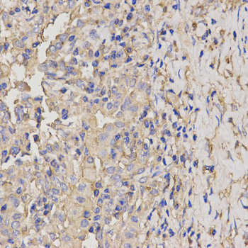 AXIN2 / Axin 2 Antibody - Immunohistochemistry of paraffin-embedded human lung cancer using AXIN2 antibody at dilution of 1:200 (x400 lens).