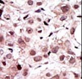 AXL Antibody - Formalin-fixed and paraffin-embedded human cancer tissue reacted with the primary antibody, which was peroxidase-conjugated to the secondary antibody, followed by AEC staining. This data demonstrates the use of this antibody for immunohistochemistry; clinical relevance has not been evaluated. BC = breast carcinoma; HC = hepatocarcinoma.