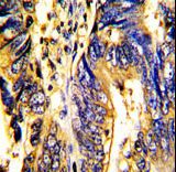 AXL Antibody - Formalin-fixed and paraffin-embedded human colon carcinoma with AXL Antibody, which was peroxidase-conjugated to the secondary antibody, followed by DAB staining. This data demonstrates the use of this antibody for immunohistochemistry; clinical relevance has not been evaluated.