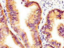AXL Antibody - Immunohistochemistry image at a dilution of 1:400 and staining in paraffin-embedded human endometrial cancer performed on a Leica BondTM system. After dewaxing and hydration, antigen retrieval was mediated by high pressure in a citrate buffer (pH 6.0) . Section was blocked with 10% normal goat serum 30min at RT. Then primary antibody (1% BSA) was incubated at 4 °C overnight. The primary is detected by a biotinylated secondary antibody and visualized using an HRP conjugated SP system.