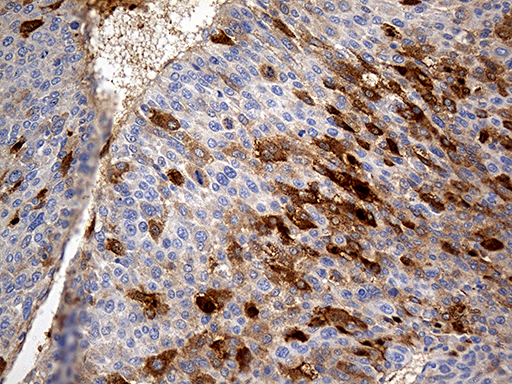 AZGP1 / ZAG Antibody - Immunohistochemical staining of paraffin-embedded Carcinoma of Human liver tissue using anti-AZGP1 mouse monoclonal antibody. (Heat-induced epitope retrieval by 1mM EDTA in 10mM Tris buffer. (pH8.5) at 120°C for 3 min. (1:2000)