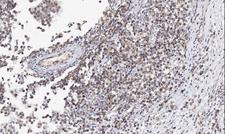 AZIN2 / Antizyme Inhibitor 2 Antibody - IHC analysis of AZIN2 using anti-AZIN2 antibody. AZIN2 was detected in paraffin-embedded section of human testicar cancer tissues. Heat mediated antigen retrieval was performed in citrate buffer (pH6, epitope retrieval solution) for 20 mins. The tissue section was blocked with 10% goat serum. The tissue section was then incubated with 1µg/ml rabbit anti-AZIN2 Antibody overnight at 4°C. Biotinylated goat anti-rabbit IgG was used as secondary antibody and incubated for 30 minutes at 37°C. The tissue section was developed using Strepavidin-Biotin-Complex (SABC) with DAB as the chromogen.