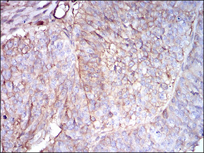 B2M / Beta 2 Microglobulin Antibody - IHC of paraffin-embedded ovarian cancer tissues using B2M mouse monoclonal antibody with DAB staining.