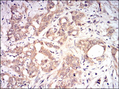 B2M / Beta 2 Microglobulin Antibody - IHC of paraffin-embedded cervical cancer tissues using B2M mouse monoclonal antibody with DAB staining.