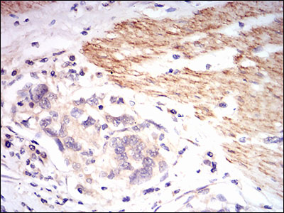 B2M / Beta 2 Microglobulin Antibody - IHC of paraffin-embedded esophageal cancer tissues using B2M mouse monoclonal antibody with DAB staining.