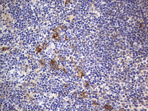 B2M / Beta 2 Microglobulin Antibody - IHC of paraffin-embedded Human lymphoma tissue using anti-B2M mouse monoclonal antibody. (Heat-induced epitope retrieval by 1 mM EDTA in 10mM Tris, pH8.5, 120°C for 3min).