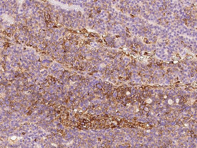 B2M / Beta 2 Microglobulin Antibody - Immunochemical staining of human B2M in human ovarian cancer with mouse monoclonal antibody at 1:60 dilution, formalin-fixed paraffin embedded sections.