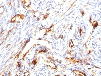 B2M / Beta 2 Microglobulin Antibody - Formalin-fixed, paraffin-embedded human endometrial carcinoma stained with Beta-2-Microglobulin antibody (B2M/1118).  This image was taken for the unmodified form of this product. Other forms have not been tested.