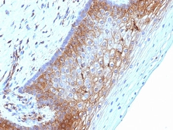 B2M / Beta 2 Microglobulin Antibody - Formalin-fixed, paraffin-embedded human cervical carcinoma stained with Beta-2-Microglobulin antibody (B2M/1118).  This image was taken for the unmodified form of this product. Other forms have not been tested.