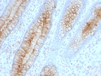 B2M / Beta 2 Microglobulin Antibody - Formalin-fixed, paraffin-embedded human colon carcinoma stained with Beta-2-Microglobulin antibody (B2M/961).  This image was taken for the unmodified form of this product. Other forms have not been tested.