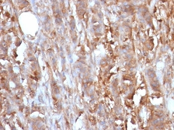 B2M / Beta 2 Microglobulin Antibody - Formalin-fixed, paraffin-embedded human cervical carcinoma stained with Beta-2-Microglobulin antibody.  This image was taken for the unmodified form of this product. Other forms have not been tested.