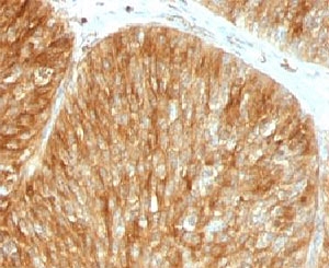 B2M / Beta 2 Microglobulin Antibody - Formalin-fixed, paraffin-embedded human bladder carcinoma stained with Beta-2-Microglobulin antibody.  This image was taken for the unmodified form of this product. Other forms have not been tested.