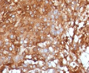 B2M / Beta 2 Microglobulin Antibody - Formalin-fixed, paraffin-embedded human melanoma stained with Beta-2-Microglobulin antibody.  This image was taken for the unmodified form of this product. Other forms have not been tested.