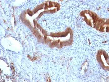 B2M / Beta 2 Microglobulin Antibody - Formalin-fixed, paraffin-embedded human endometrial carcinoma stained with Beta-2-Microglobulin antibody.  This image was taken for the unmodified form of this product. Other forms have not been tested.