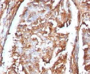 B2M / Beta 2 Microglobulin Antibody - Formalin-fixed, paraffin-embedded human renal carcinoma stained with Beta-2-Microglobulin antibody.  This image was taken for the unmodified form of this product. Other forms have not been tested.