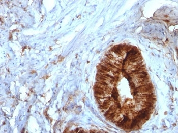 B2M / Beta 2 Microglobulin Antibody - Formalin-fixed, paraffin-embedded human cervical carcinoma stained with Beta-2-Microglobulin antibody.  This image was taken for the unmodified form of this product. Other forms have not been tested.