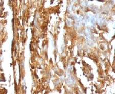 B2M / Beta 2 Microglobulin Antibody - IHC testing of human renal carcinoma with B2M antibody (clone MGBP2-1).  This image was taken for the unmodified form of this product. Other forms have not been tested.