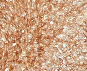 B2M / Beta 2 Microglobulin Antibody - IHC testing of human bladder carcinoma with B2M antibody (clone MGBP2-1).  This image was taken for the unmodified form of this product. Other forms have not been tested.