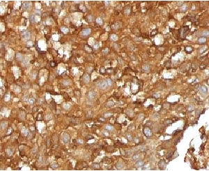 B2M / Beta 2 Microglobulin Antibody - IHC testing of human melanoma with B2M antibody (clone MGBP2-1).  This image was taken for the unmodified form of this product. Other forms have not been tested.