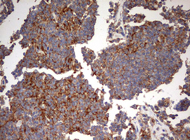 B2M / Beta 2 Microglobulin Antibody - IHC of paraffin-embedded Human lymphoma tissue using anti-B2M mouse monoclonal antibody. (Heat-induced epitope retrieval by 10mM citric buffer, pH6.0, 120°C for 3min).