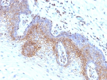 B2M / Beta 2 Microglobulin Antibody - Formalin-fixed, paraffin-embedded human cervical carcinoma stained with B2M antibody (SPM617).  This image was taken for the unmodified form of this product. Other forms have not been tested.