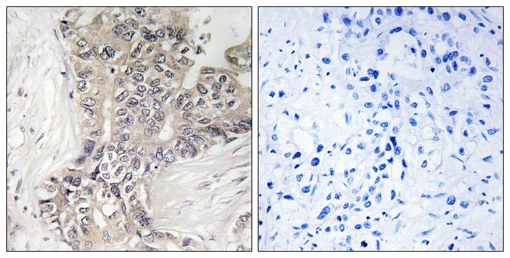 B3GALTL Antibody - Peptide - + Immunohistochemistry analysis of paraffin-embedded human liver carcinoma tissue using B3GALTL antibody.