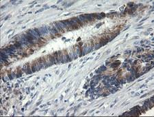 B3GNT2 Antibody - IHC of paraffin-embedded Adenocarcinoma of Human colon tissue using anti-B3GNT2 mouse monoclonal antibody.
