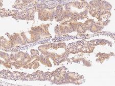 B3GNT2 Antibody - Immunochemical staining of human B3GNT2 in human colon carcinoma with rabbit polyclonal antibody at 1:1000 dilution, formalin-fixed paraffin embedded sections.