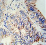 B3GNT6 Antibody - B3GNT6 Antibody immunohistochemistry of formalin-fixed and paraffin-embedded human colon carcinoma followed by peroxidase-conjugated secondary antibody and DAB staining.