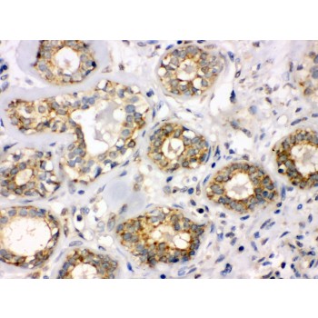 B3GNT8 Antibody - B3GNT8 antibody IHC-paraffin. IHC(P): Human Mammary Cancer Tissue.