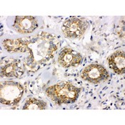 B3GNT8 Antibody - B3GNT8 antibody IHC-paraffin. IHC(P): Human Mammary Cancer Tissue.